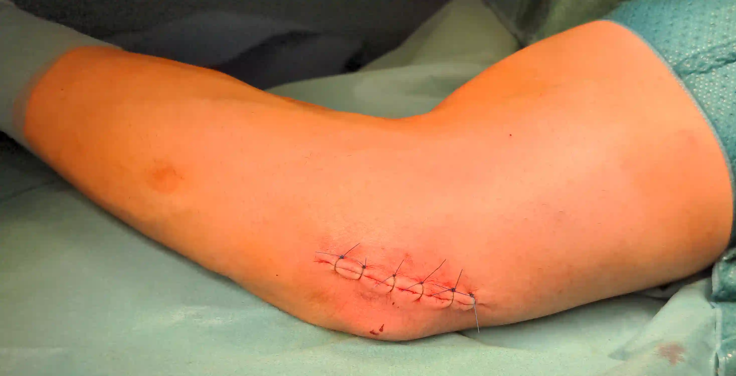 Kubitaltunnelsyndrom postoperativ