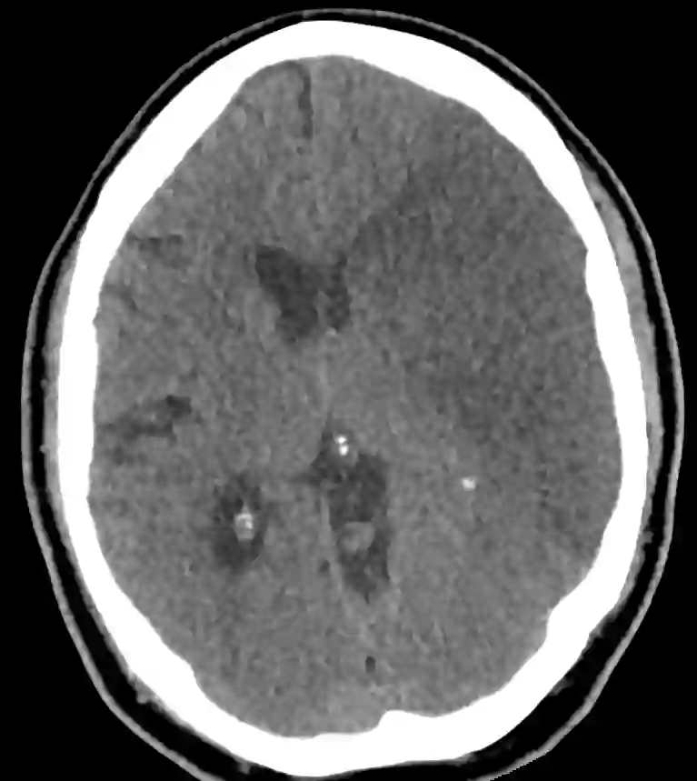 Maligner Mediainfarkt CT