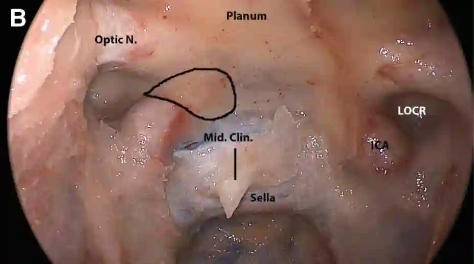 Medial and lateral opticocarotid recess