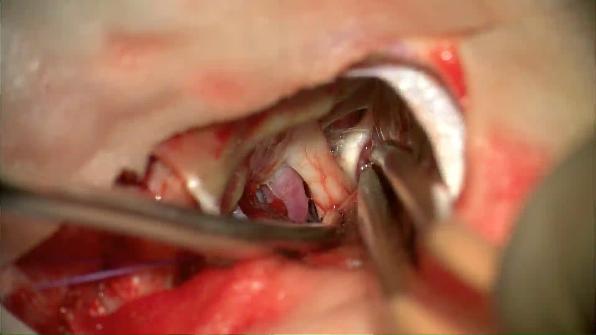 Nervus opticus intraoperativ