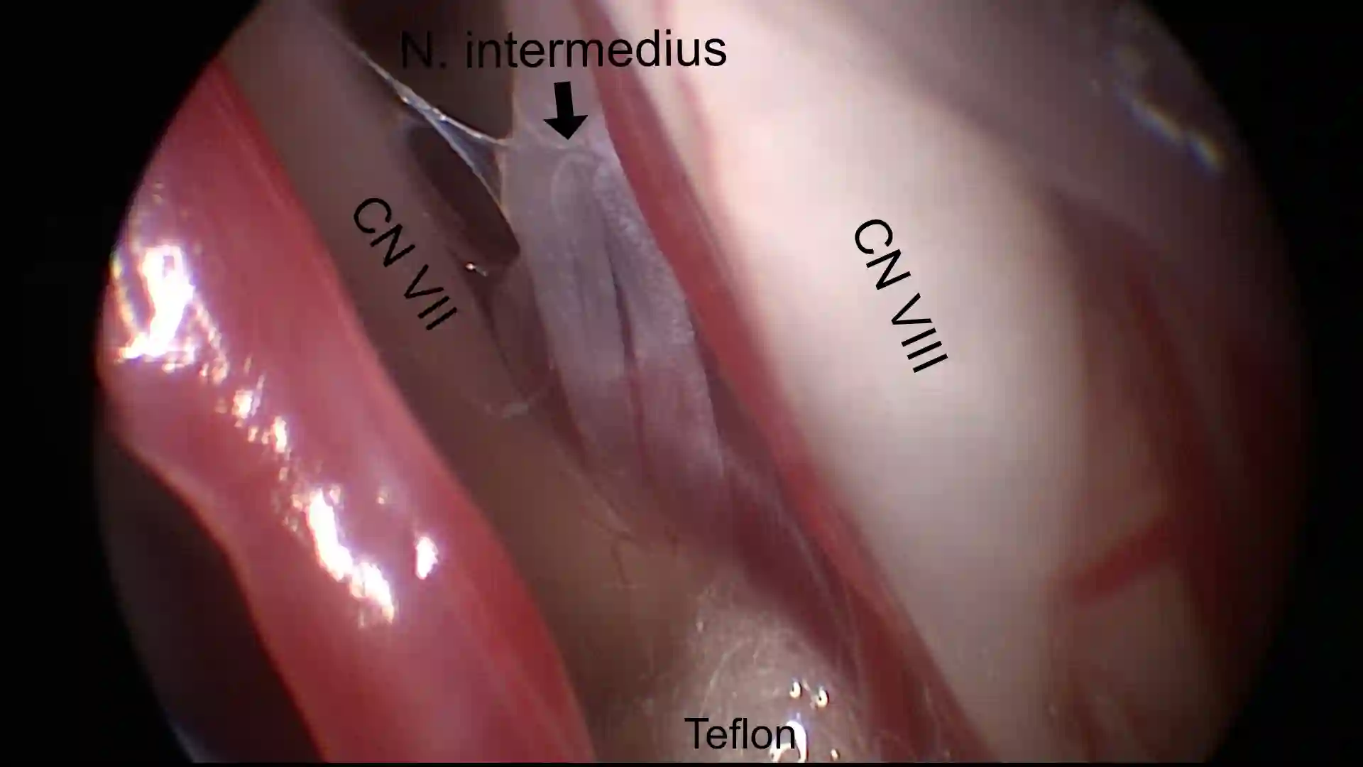 Nervus intermedius intraoperativ