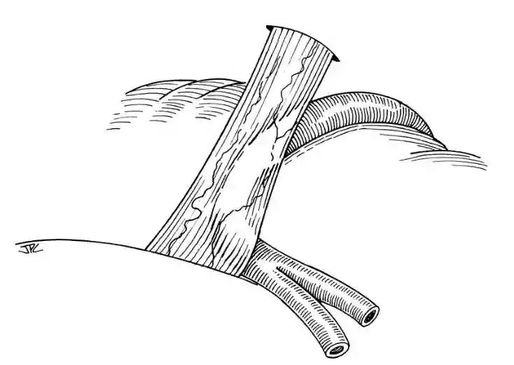 Neurovasulärer Konflikt des Nervus trigeminus.