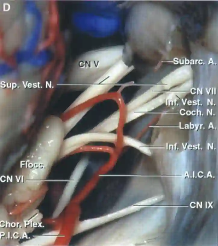 Nervus trigeminus retrosigmoidal
