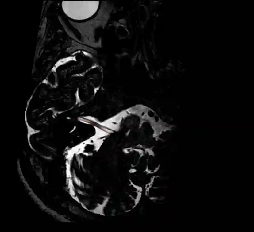 Nervus vestibulocochlearis im MRT