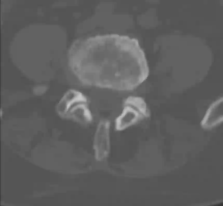 Linksseitige Neuroforamenstenose