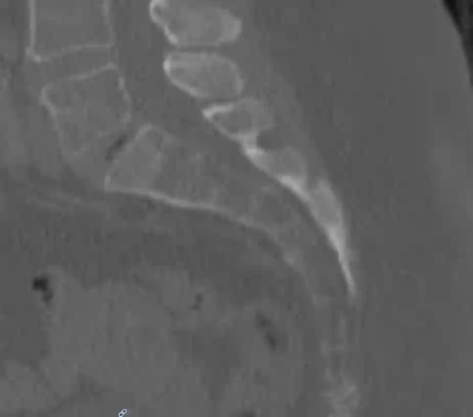 Sagittales CT Bild des Os sacrum