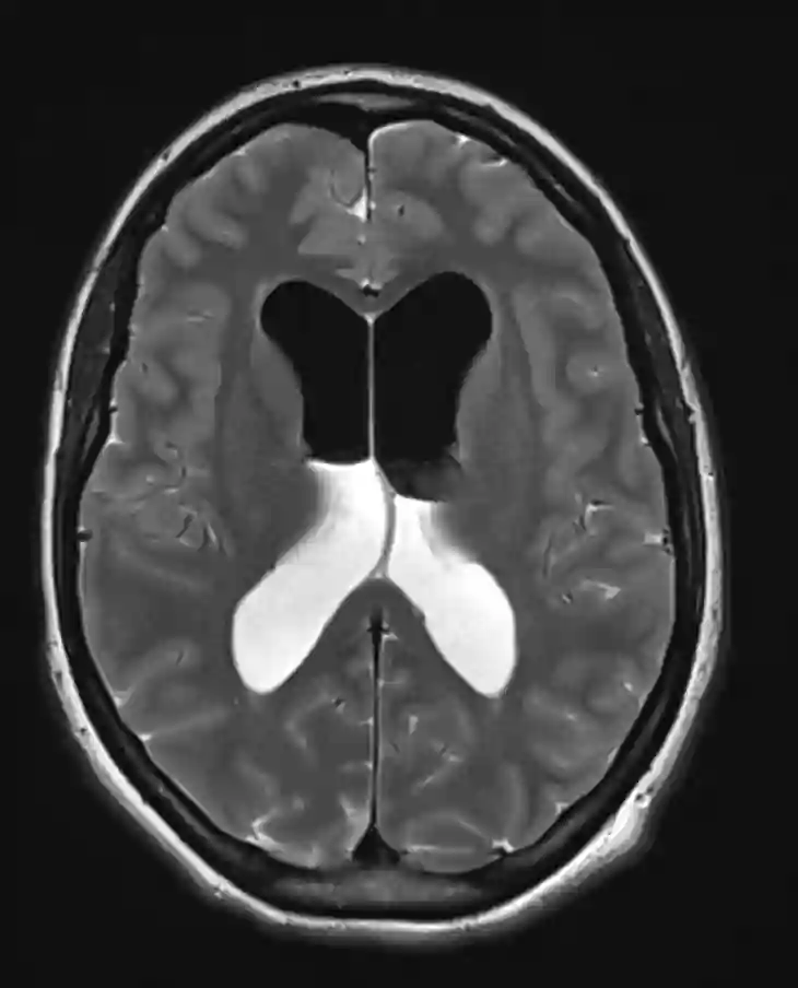 Pneumocephalus MRT