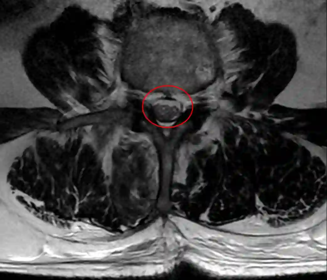 Spinalkanal axiales MRT