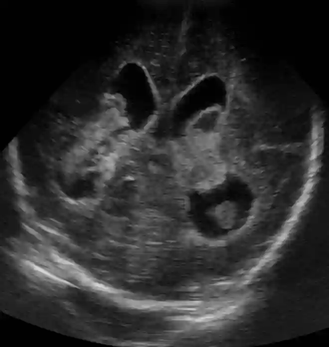 Subependymale Blutung Ultraschall