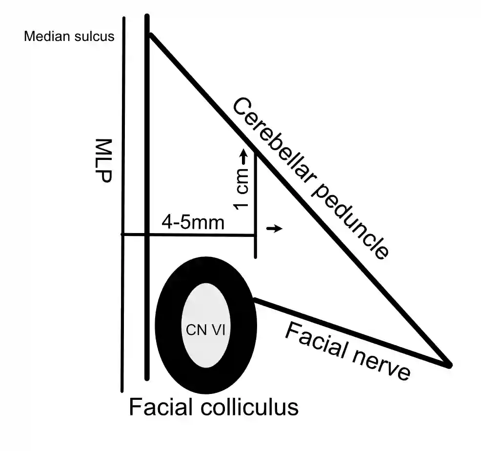 Suprafacial Triangel Schematisch