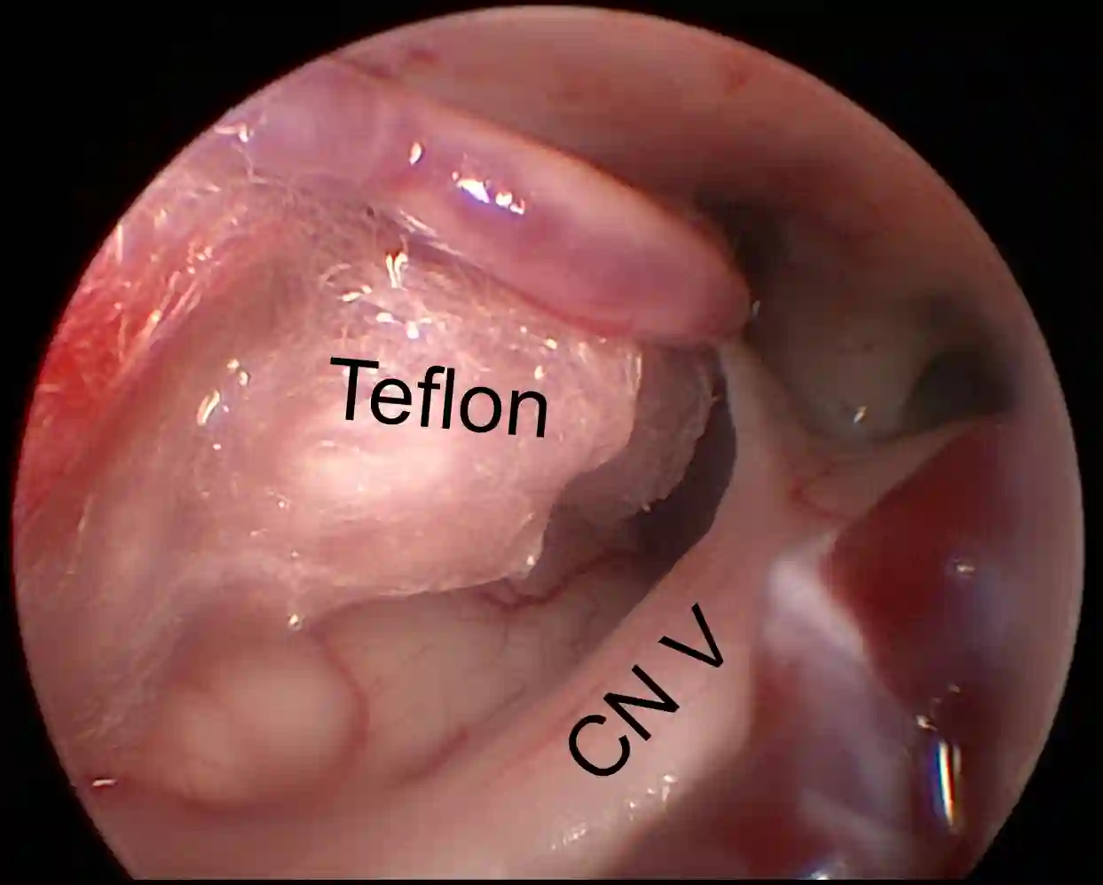 Intraoperative Teflon Ansicht