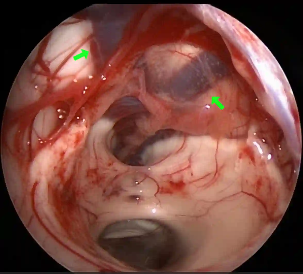 Vena cerebri interna