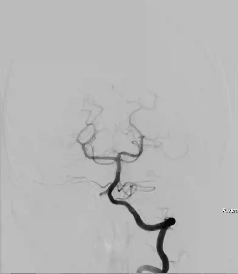 Arteria vertebralis in einer DSA