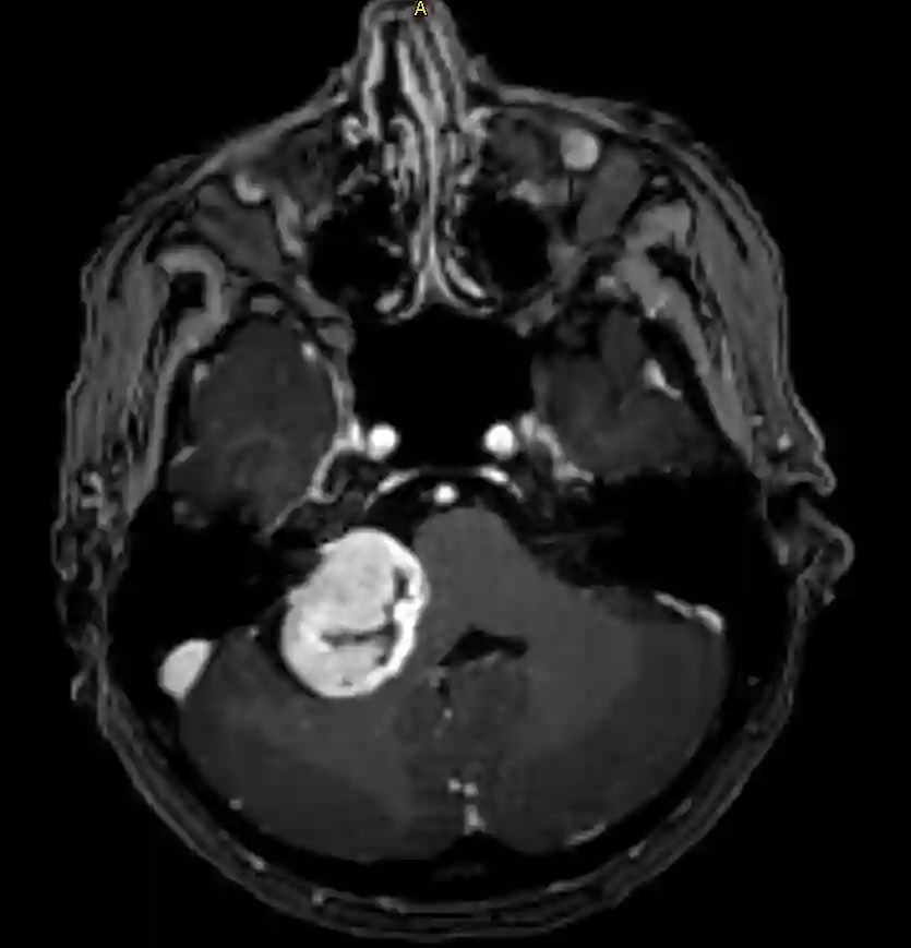 Vestibularisschwannom im MRI