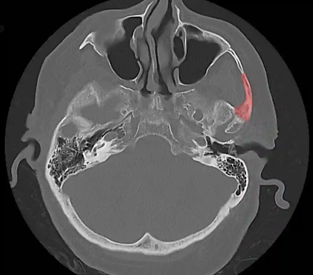 Zygoma CT
