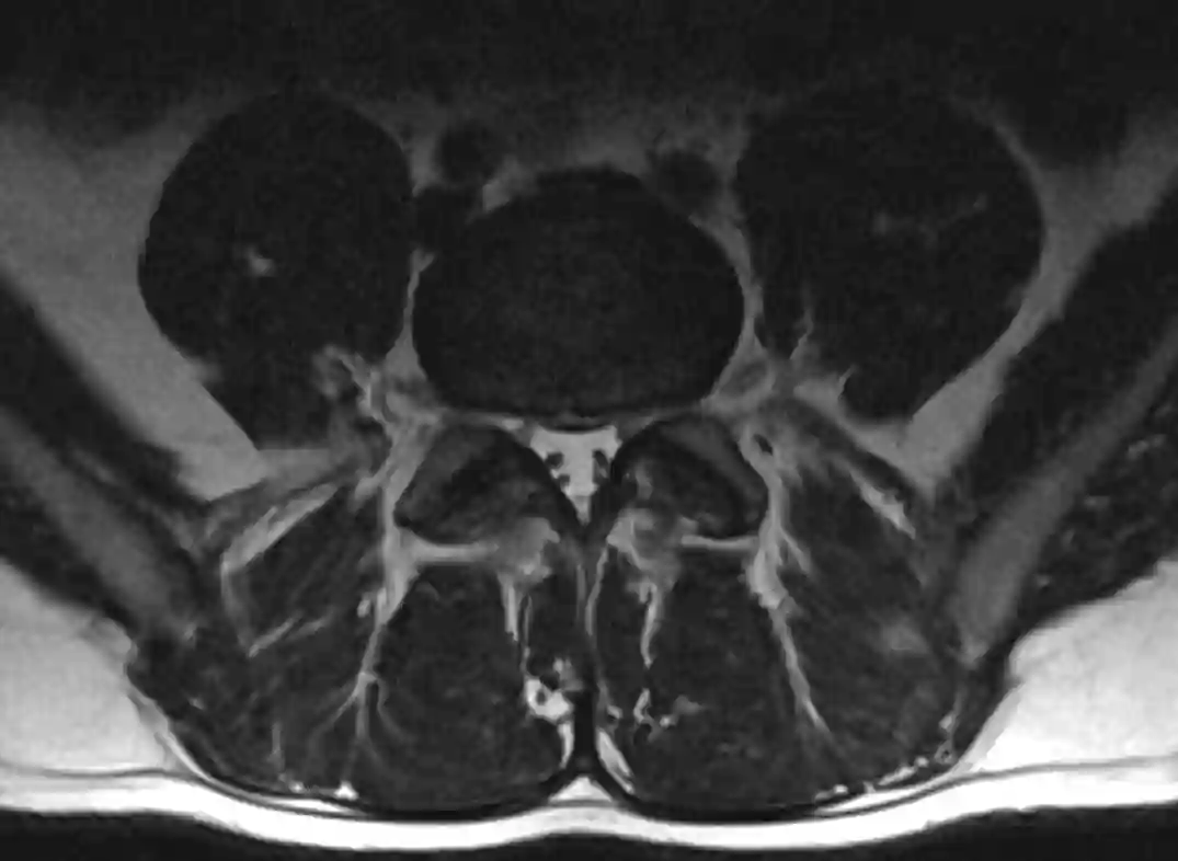 Riss im Anulus Fibrosus der Bandscheibe