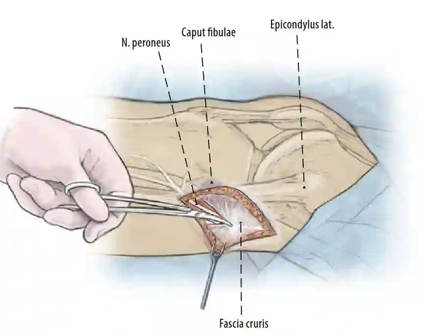 Dekompression des Nervus peroneus am Fibulaköpfchen