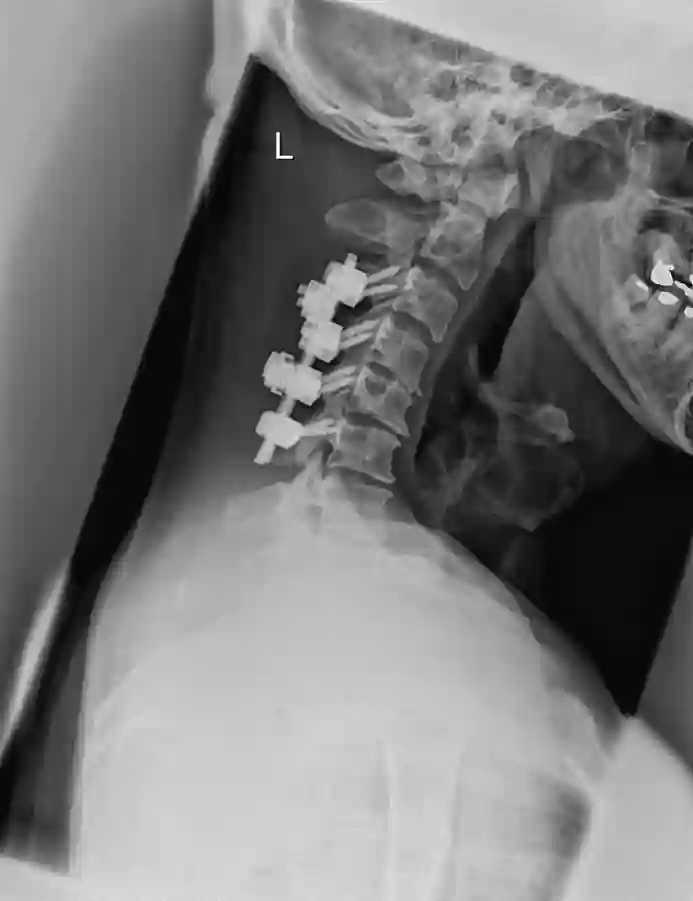 Dorsale Spondylodese zwischen dem 3. und 6. Halswirbelkörper.