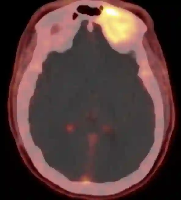 DOTATOC PET CT