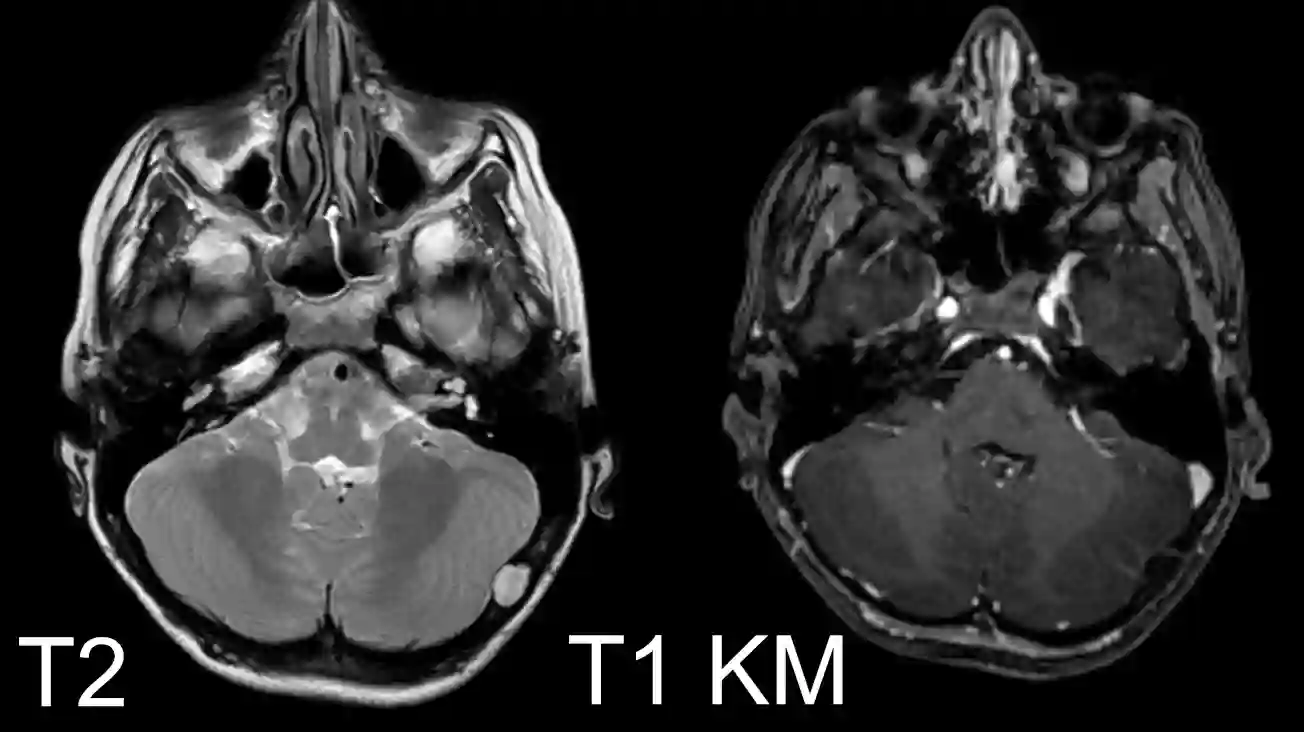 Epidermoidzyste MRT