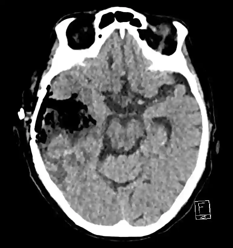 Fibrillar im CT