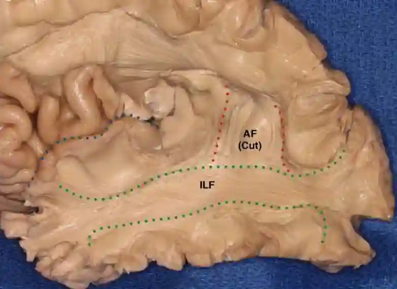 Fasciculus longitudinalis inferior cerebri Präparat