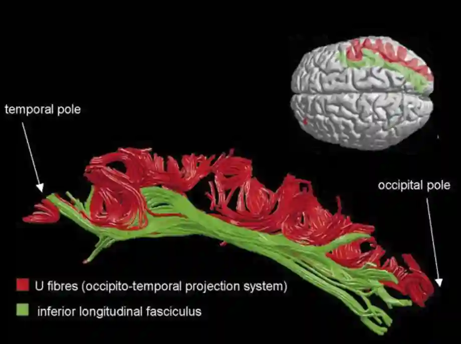 Fasciculus longitudinalis inferior cerebri (ILF)