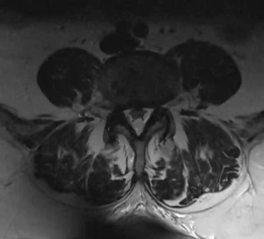 Spinale Lipomatose MRT