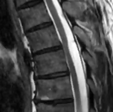 Myelonherniation