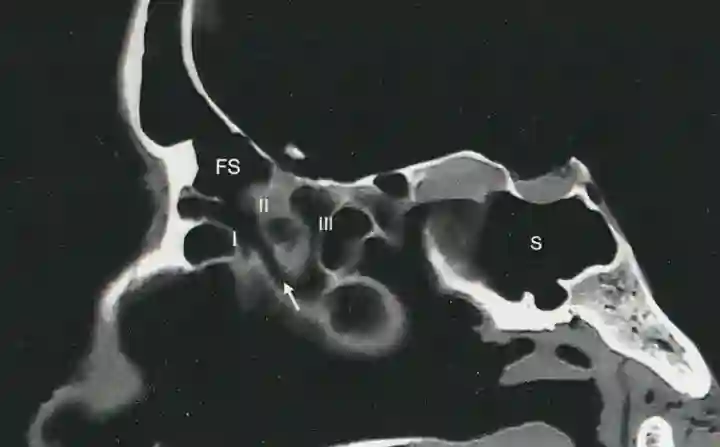 Ductus frontonasalis im CT
