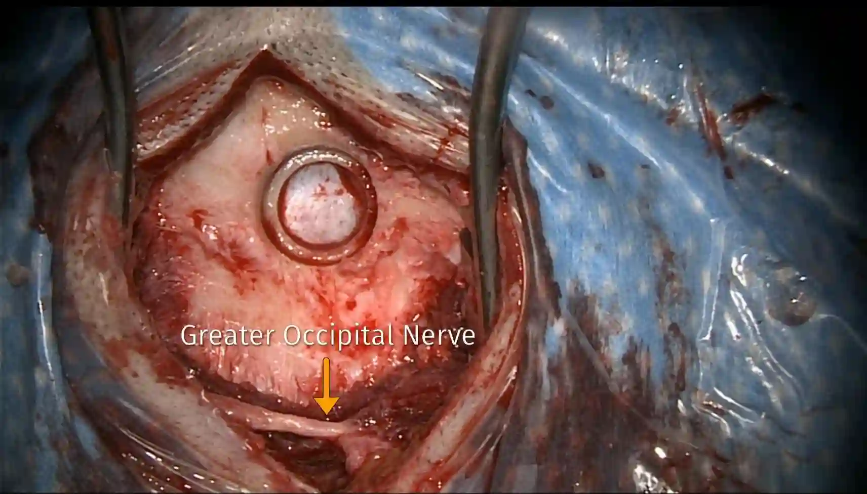 Nervus occipitalis major intraoperativ