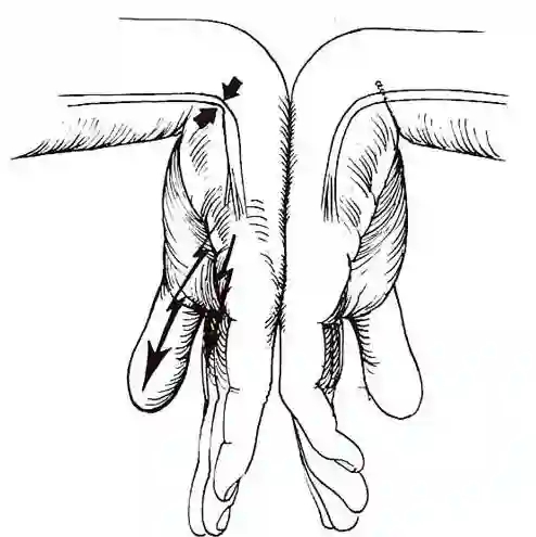 Phalen Test