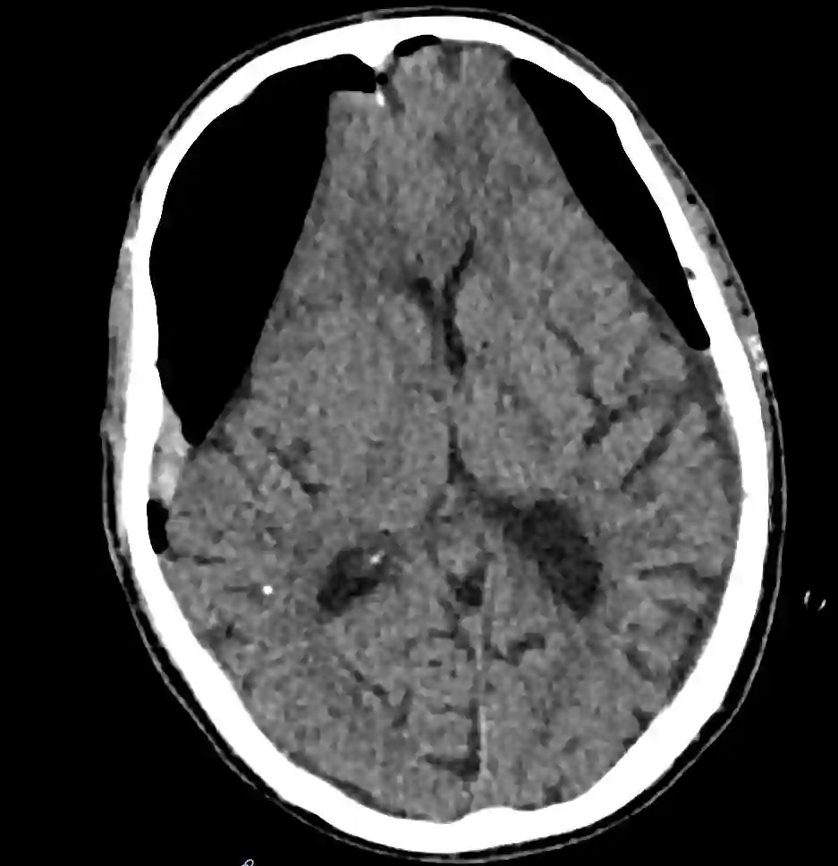 Postoperativer Pneumocephalus