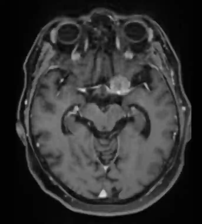 Processus clinoideus meningeom MRT