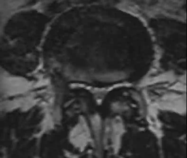 MRT relative Spinalkanalstenose