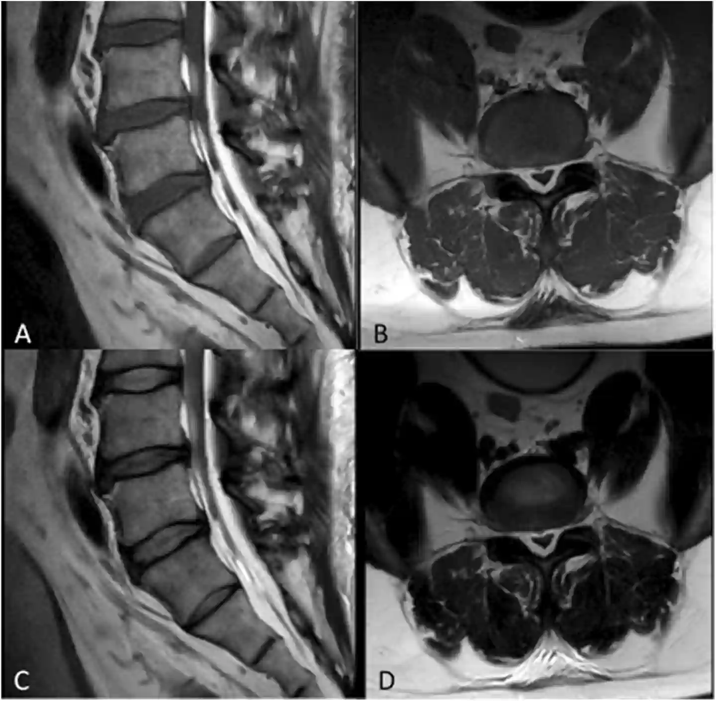 MRT spinale epidurale Lipomatose