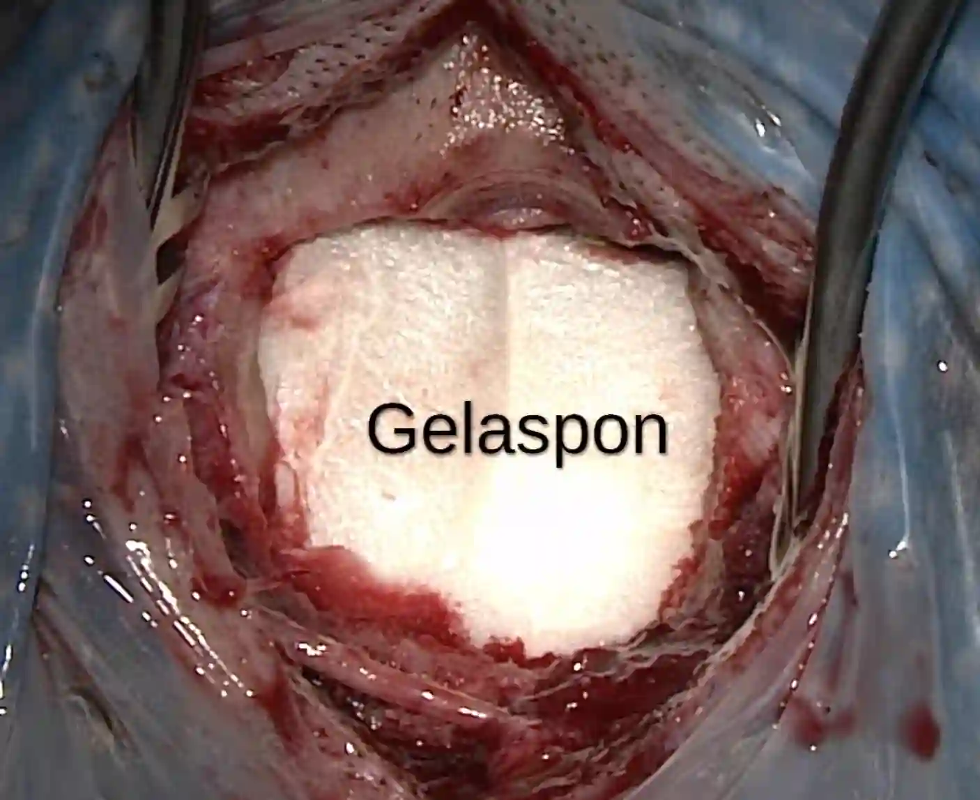Spongostan Intraoperativ