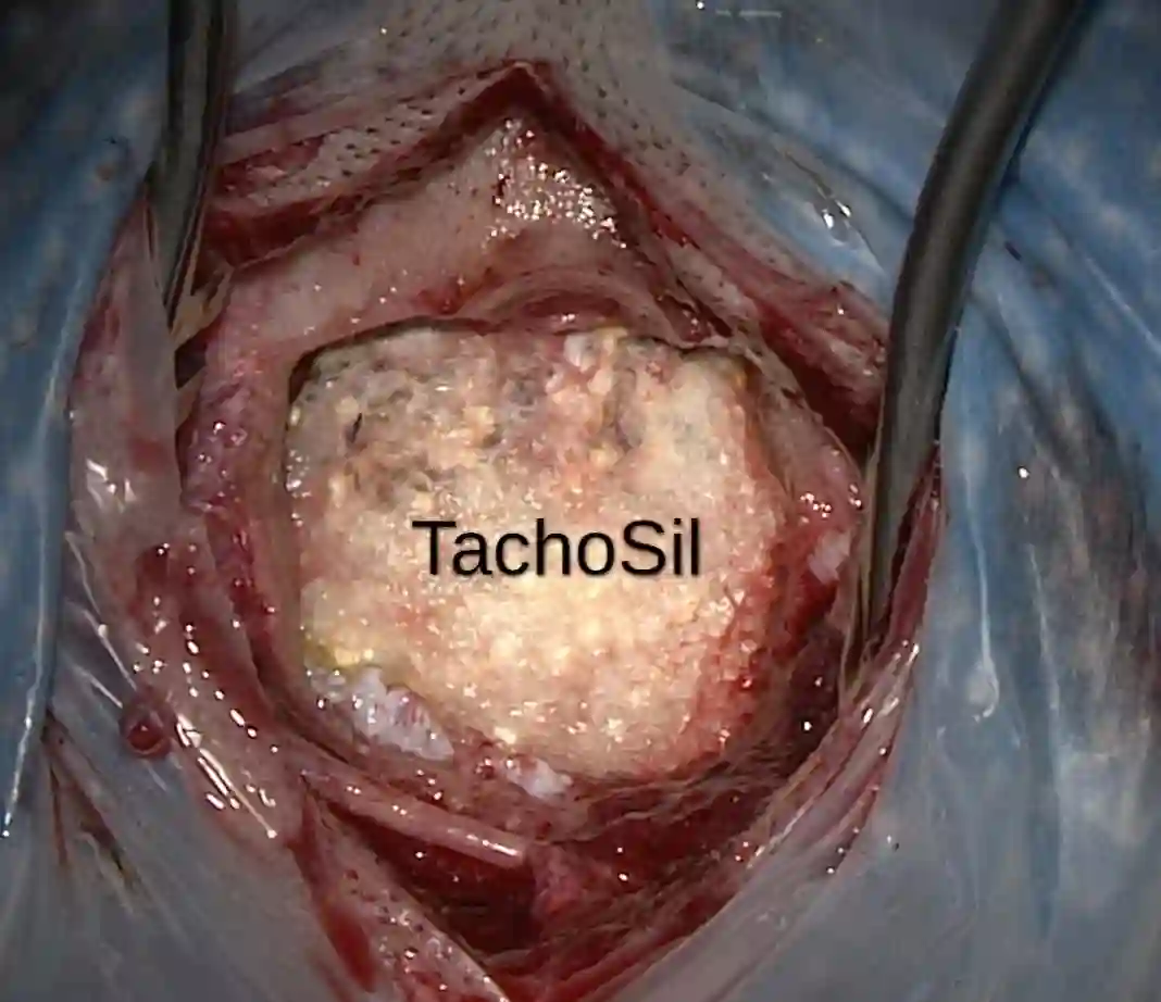 TachoSil Intraoperativ