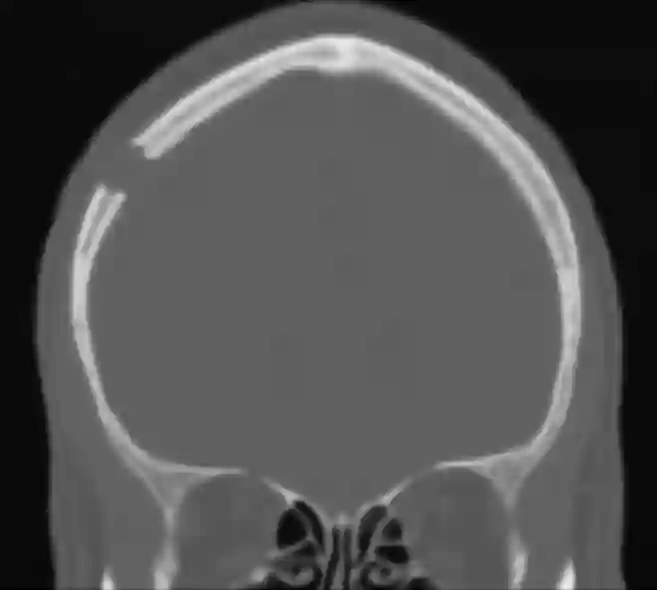 Bohrlochtrepanation CT