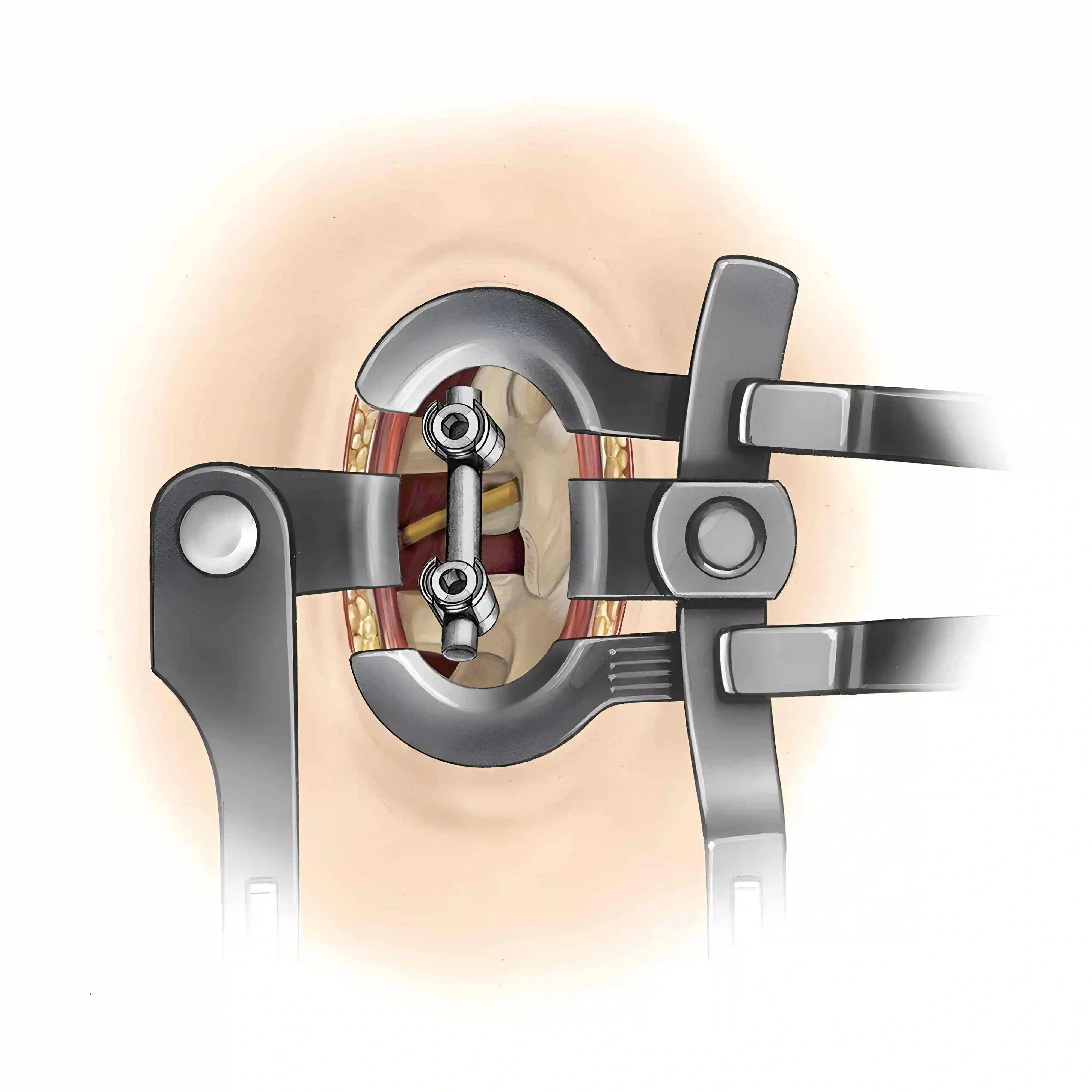 Caspar Sperrer Intraoperativ