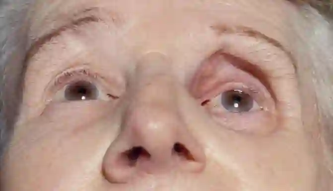 Enophthalmus