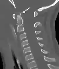 Ossiculum terminale CT