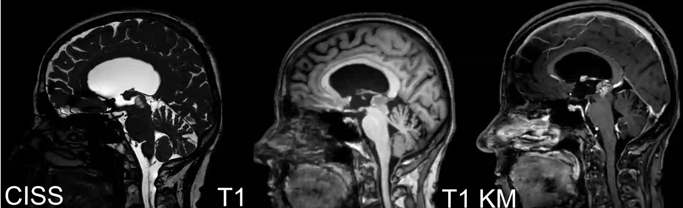Papillärer Tumor der Pinealisloge