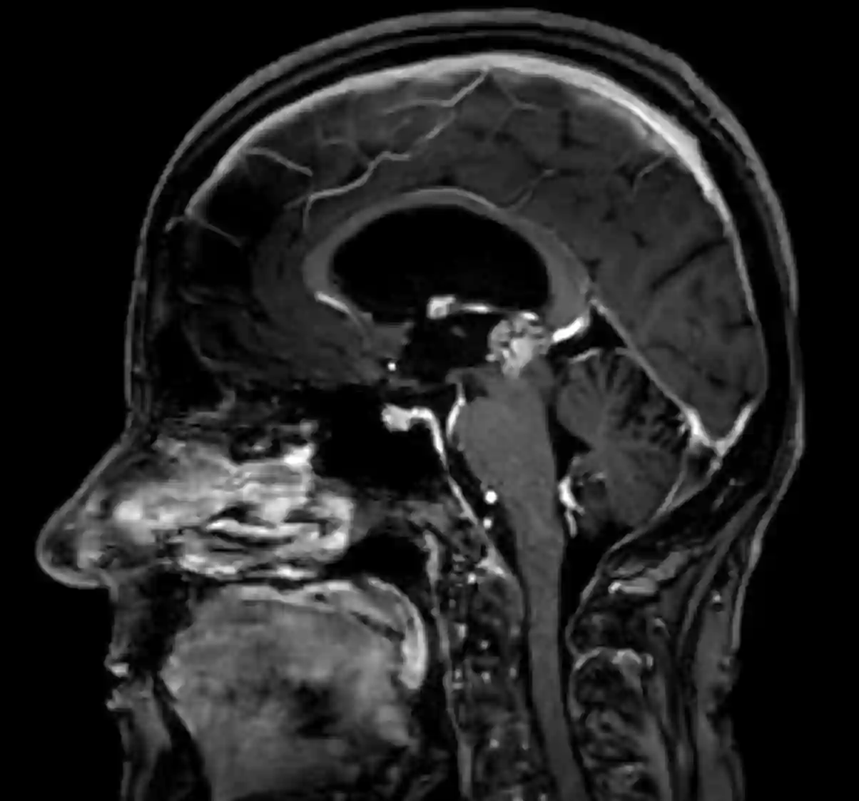 Papillärer Tumor der Pinealisloge MRT