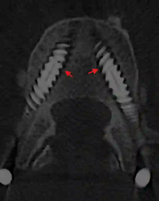 Pedikelschraubenlockerungssaum im CT