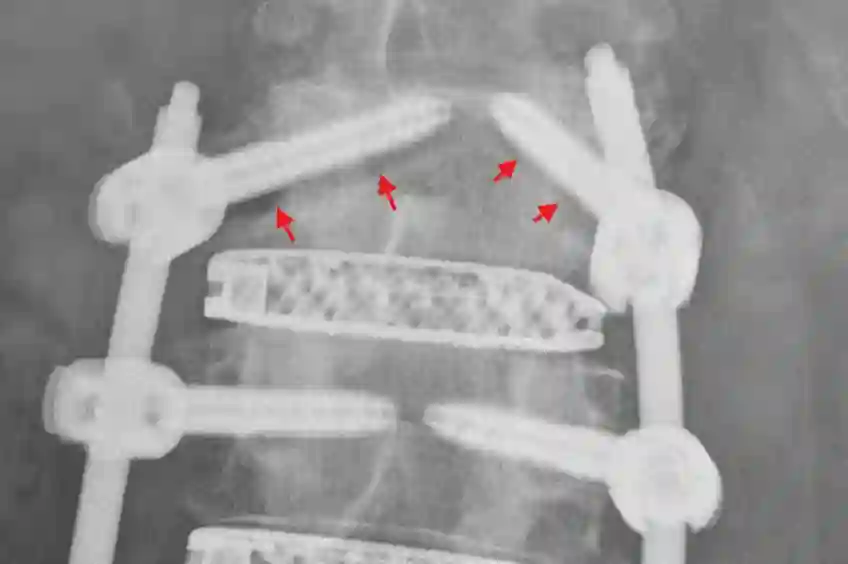 Pedikelschraubenlockerung Röntgen