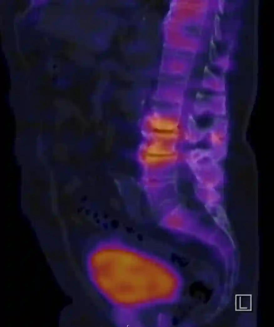 SPECT/CT Wirbelsäule