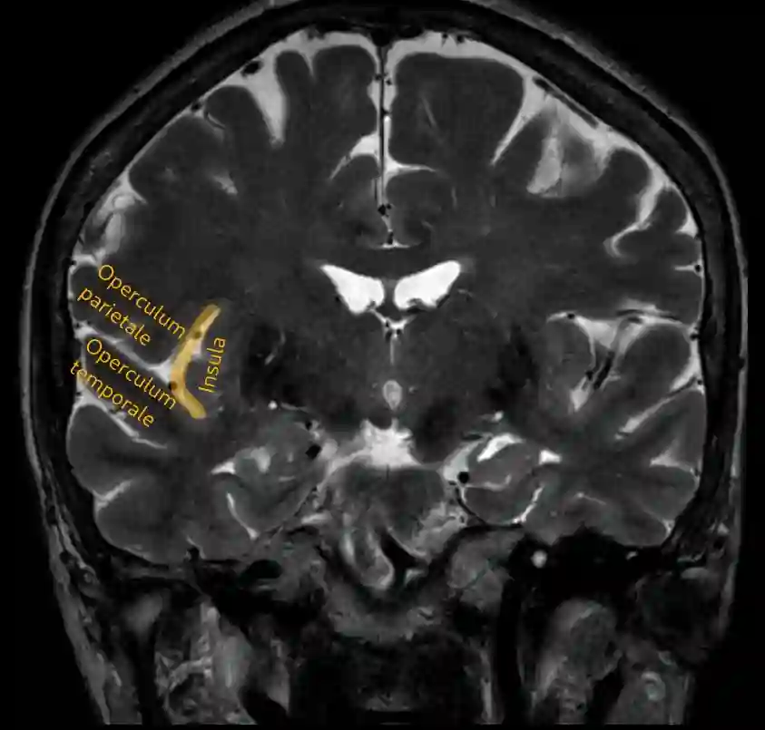 Sulcus circularis insulae