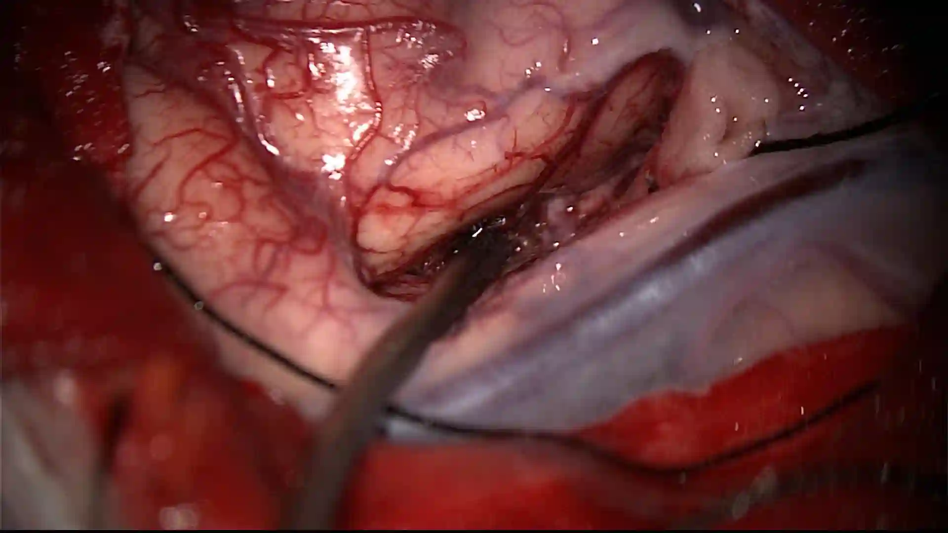 Intraoperativer Sulcus