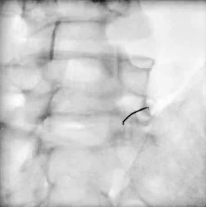 Facettengelenksinfiltration LWK5/SWK1.